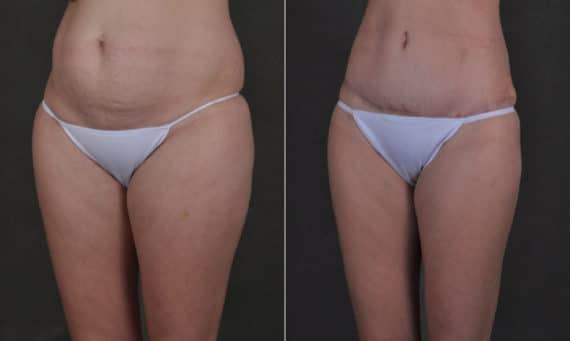 Tummy Tuck Before and After Photos in Omaha, NE, Case 17520