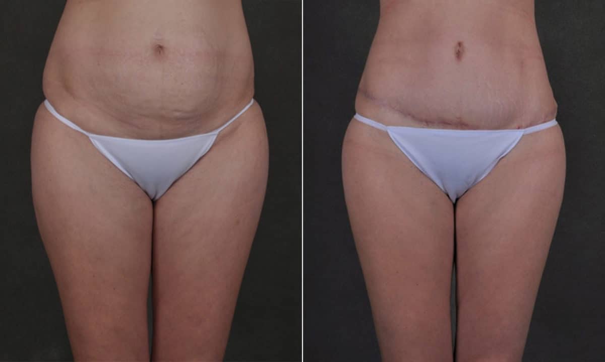 Case 17520, Tummy Tuck Before and After Photos Tummy Tuck Before and After Photos in Omaha, NE, Case 17520