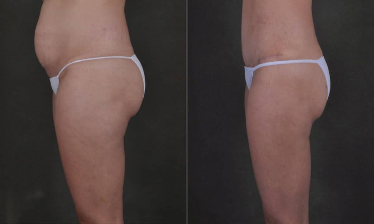 Tummy Tuck Before and After Photos in Omaha, NE, Case 17520