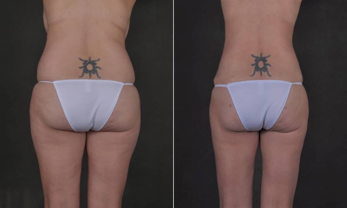 Case 17520, Tummy Tuck Before and After Photos Tummy Tuck Before and After Photos in Omaha, NE, Case 17520