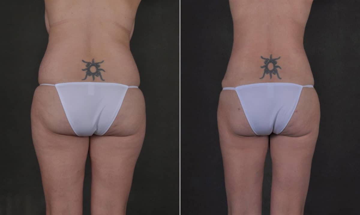 Liposuction Before and After Photos in Omaha, NE, Case 17550