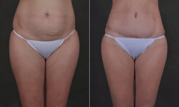 Liposuction Before and After Photos in Omaha, NE, Case 17550