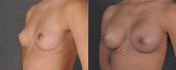 Breast Augmentation Before and After Photos in Omaha, NE, Case 17555