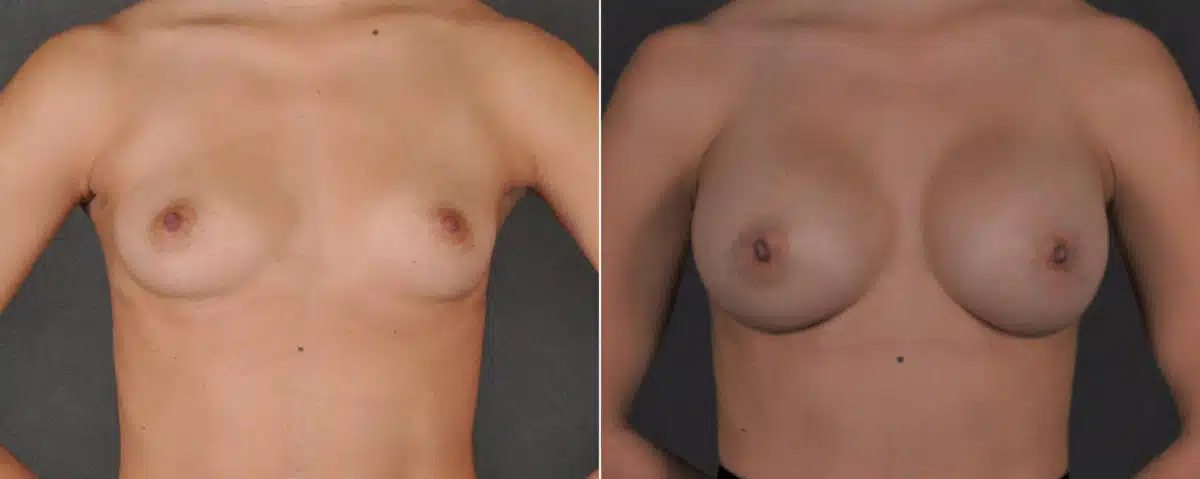 Breast Augmentation Before and After Photos in Omaha, NE, Case 17555