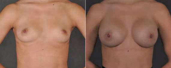 Breast Augmentation Before and After Photos in Omaha, NE, Case 17555