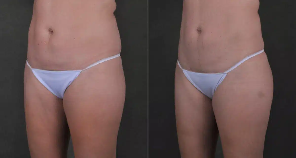 Liposuction Before and After Photos in Omaha, NE, Case 17565