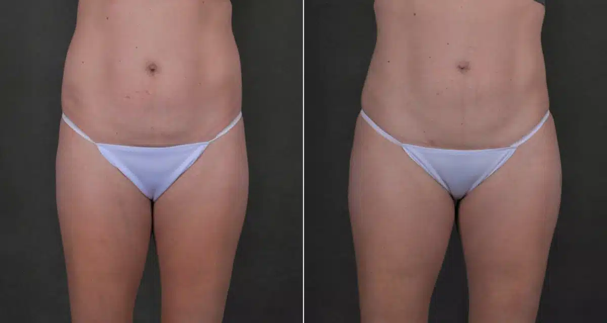 Liposuction Before and After Photos in Omaha, NE, Case 17565