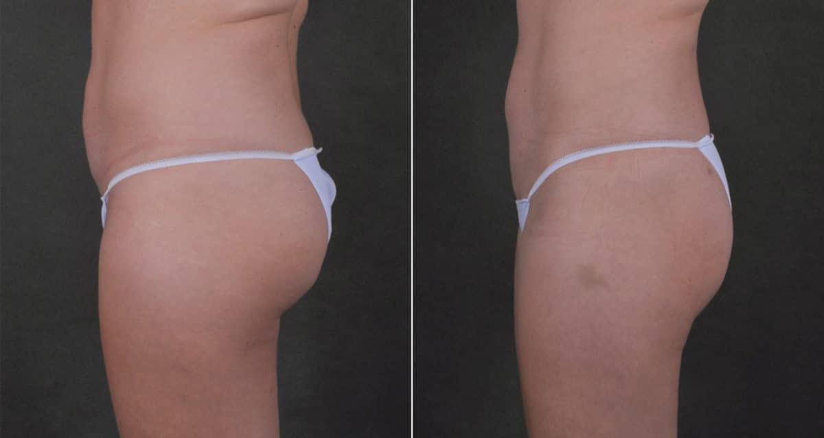 Liposuction Before and After Photos in Omaha, NE, Case 17565