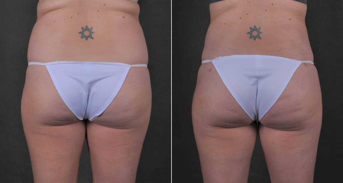 Liposuction Before and After Photos in Omaha, NE, Case 17565