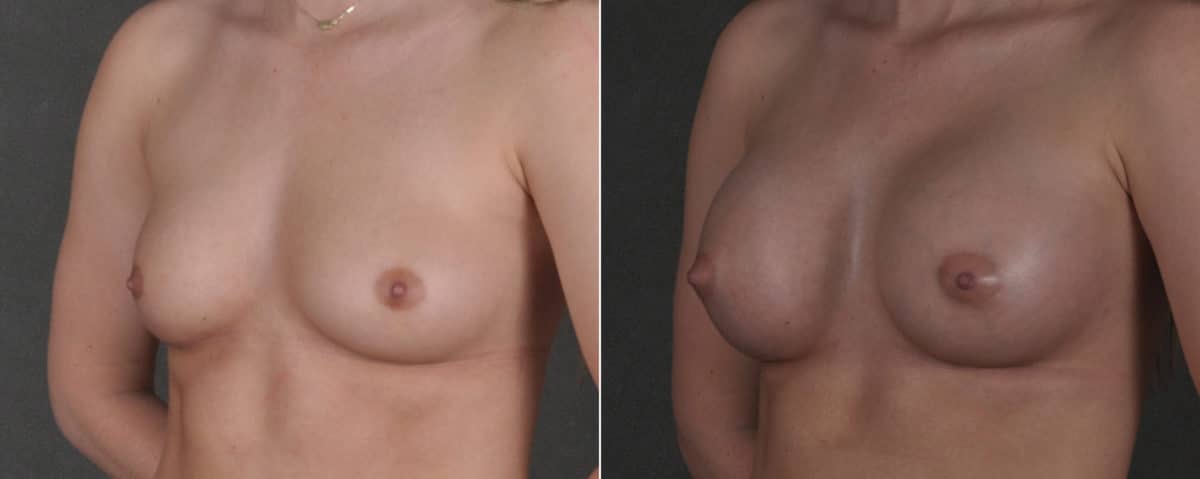 Breast Augmentation Before and After Photos in Omaha, NE, Case 17579