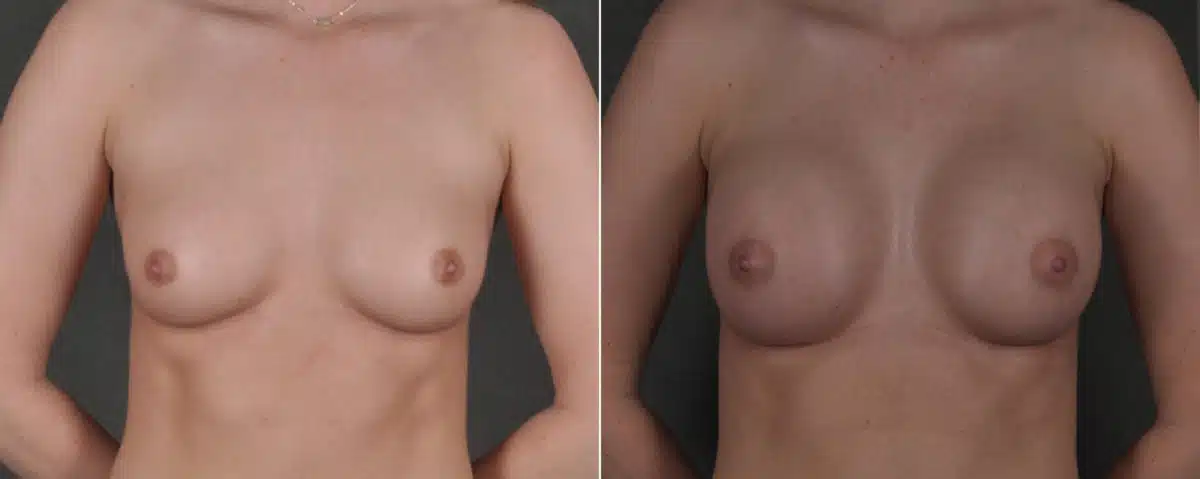 Breast Augmentation Before and After Photos in Omaha, NE, Case 17579