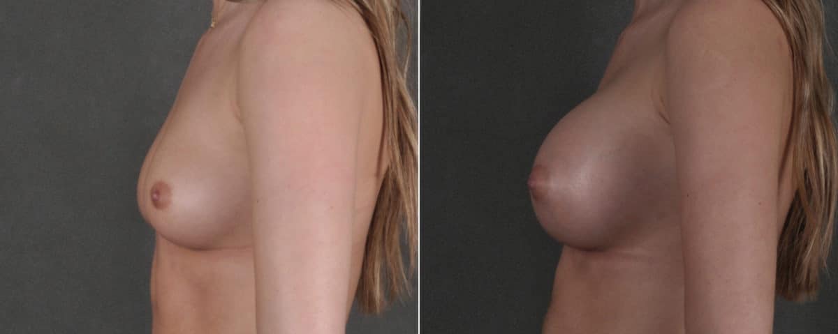 Breast Augmentation Before and After Photos in Omaha, NE, Case 17579