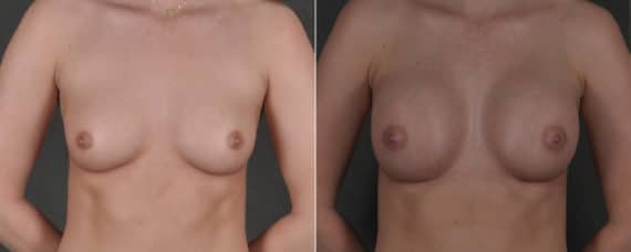 Breast Augmentation Before and After Photos in Omaha, NE, Case 17579