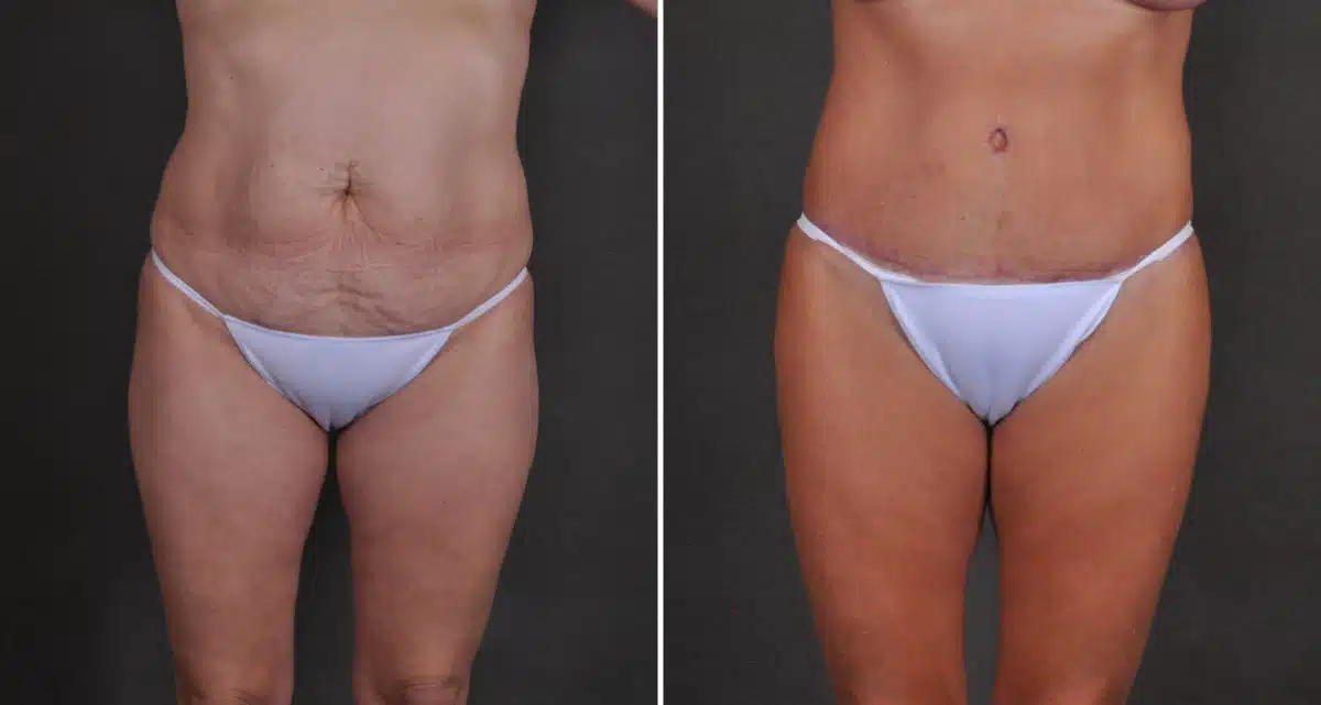 Tummy Tuck Before and After Photos in Omaha, NE, Case 10497