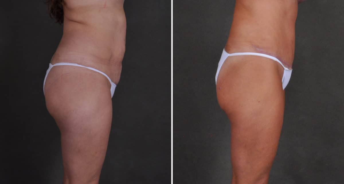 Tummy Tuck Before and After Photos in Omaha, NE, Case 10497