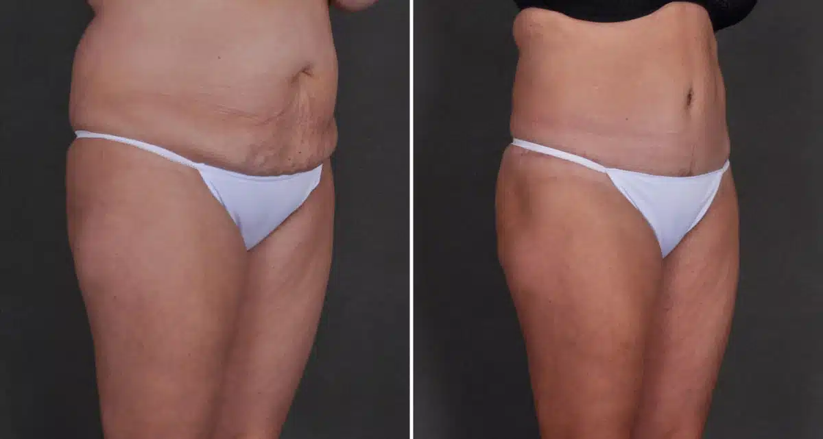 Case 9833, Tummy Tuck Before and After Photos Tummy Tuck Before and After Photos in Omaha, NE, Case 9833