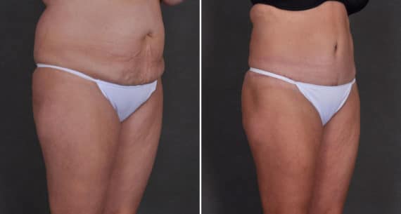 Tummy Tuck Before and After Photos in Omaha, NE, Case 9833