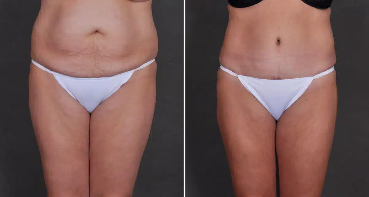 Tummy Tuck Before and After Photos in Omaha, NE, Case 9833