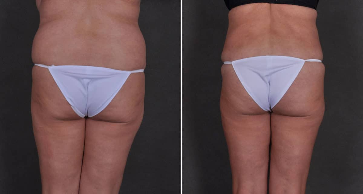 Case 9833, Tummy Tuck Before and After Photos Tummy Tuck Before and After Photos in Omaha, NE, Case 9833