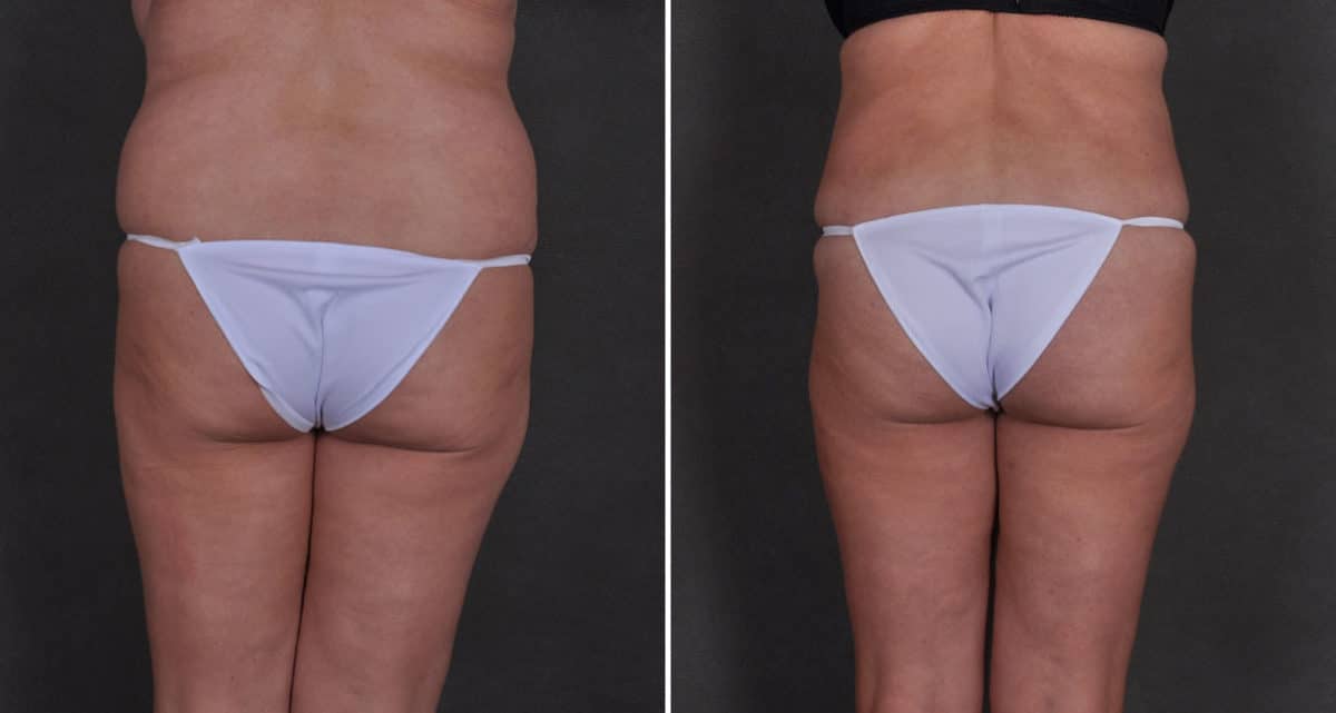 Tummy Tuck Before and After Photos in Omaha, NE, Case 9833