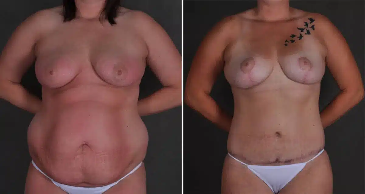 Breast Lift Before and After Photos in Omaha, NE, Case 10367