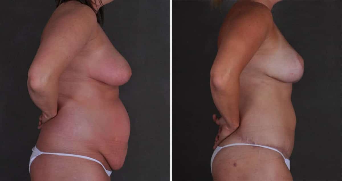 Breast Lift Before and After Photos in Omaha, NE, Case 10367