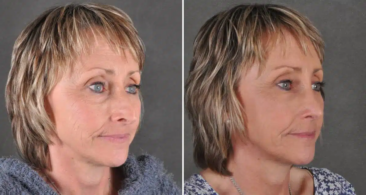 Rhinoplasty Before and After Photos in Omaha, NE, Case 15947