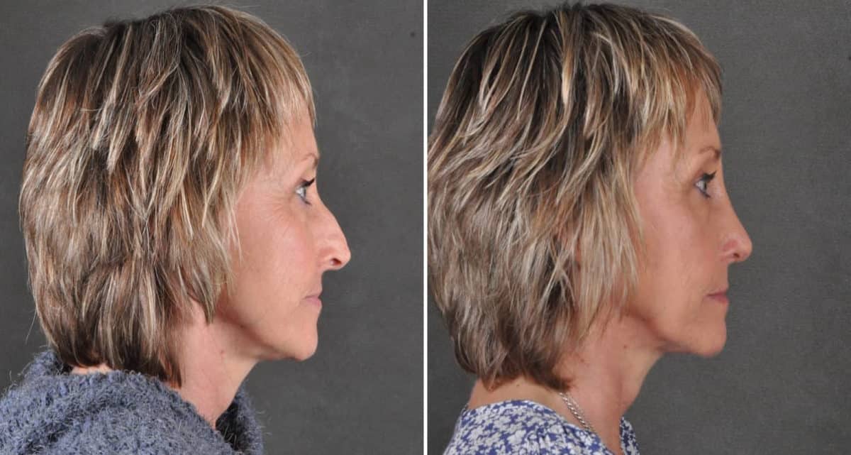 Rhinoplasty Before and After Photos in Omaha, NE, Case 15947