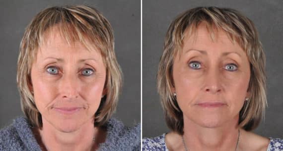 Rhinoplasty Before and After Photos in Omaha, NE, Case 15947