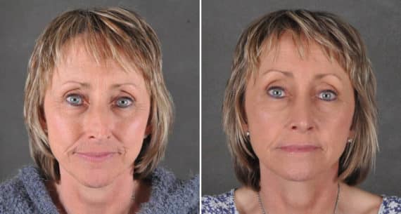 Rhinoplasty Before and After Photos in Omaha, NE, Case 15947