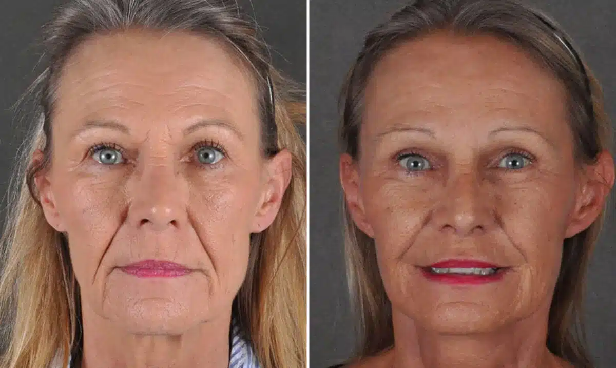 Blepharoplasty Before and After Photos in Omaha, NE, Case 16806