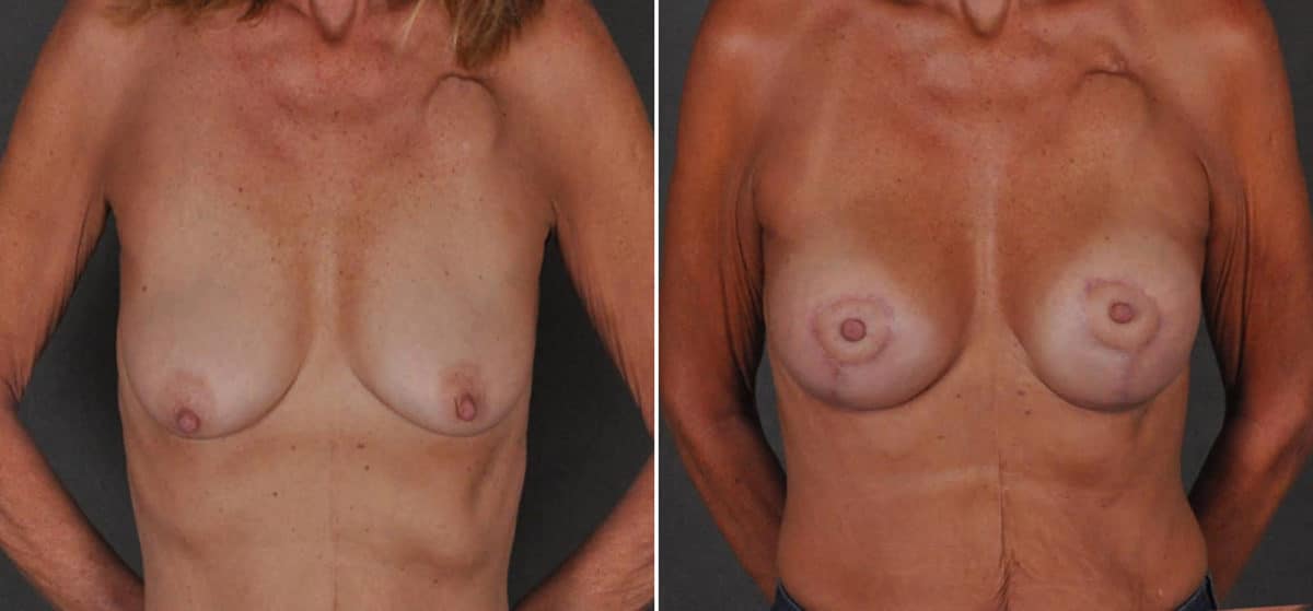 Breast Lift Before and After Photos in Omaha, NE, Case 16905