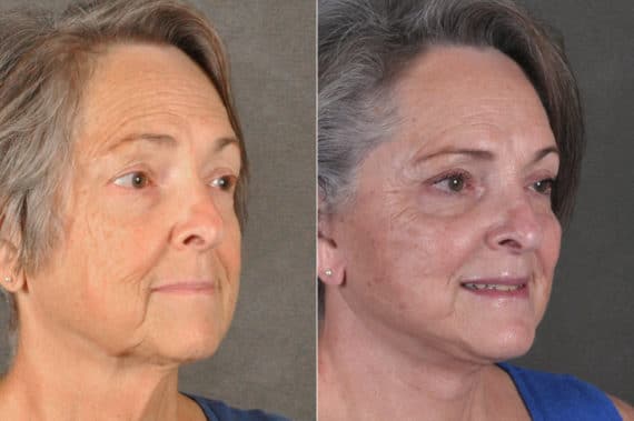 Blepharoplasty Before and After Photos in Omaha, NE, Case 17168