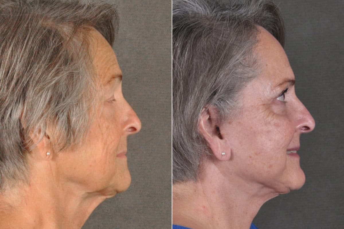 Blepharoplasty Before and After Photos in Omaha, NE, Case 17168