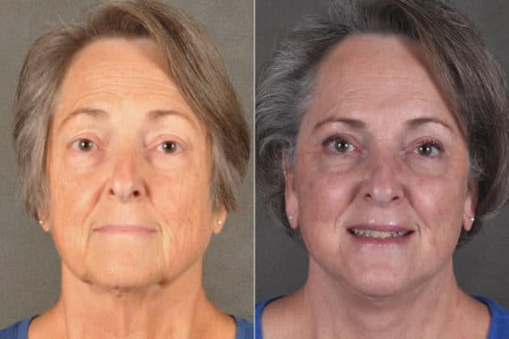 Blepharoplasty Before and After Photos in Omaha, NE, Case 17168