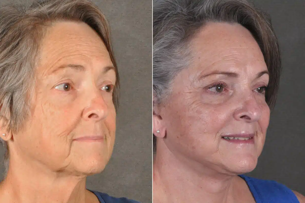 Facelift Before and After Photos in Omaha, NE, Case 17170