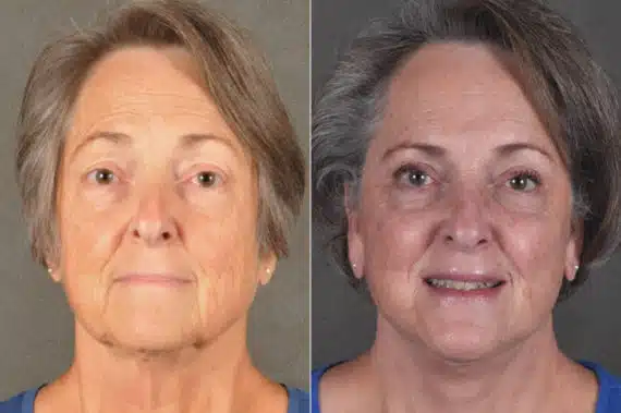 Facelift Before and After Photos in Omaha, NE, Case 17170