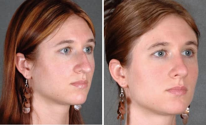 Rhinoplasty Before and After Photos in Omaha, NE, Case 5798