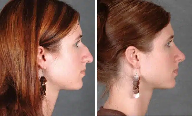 Rhinoplasty Before and After Photos in Omaha, NE, Case 5798