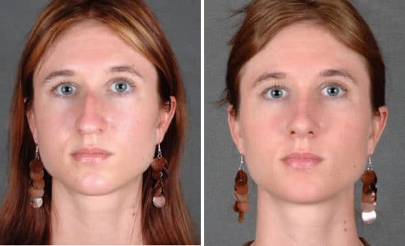 Rhinoplasty Before and After Photos in Omaha, NE, Case 5798