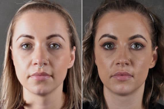 Botox Cosmetic Before and After Photos in Omaha, NE, Case 17230