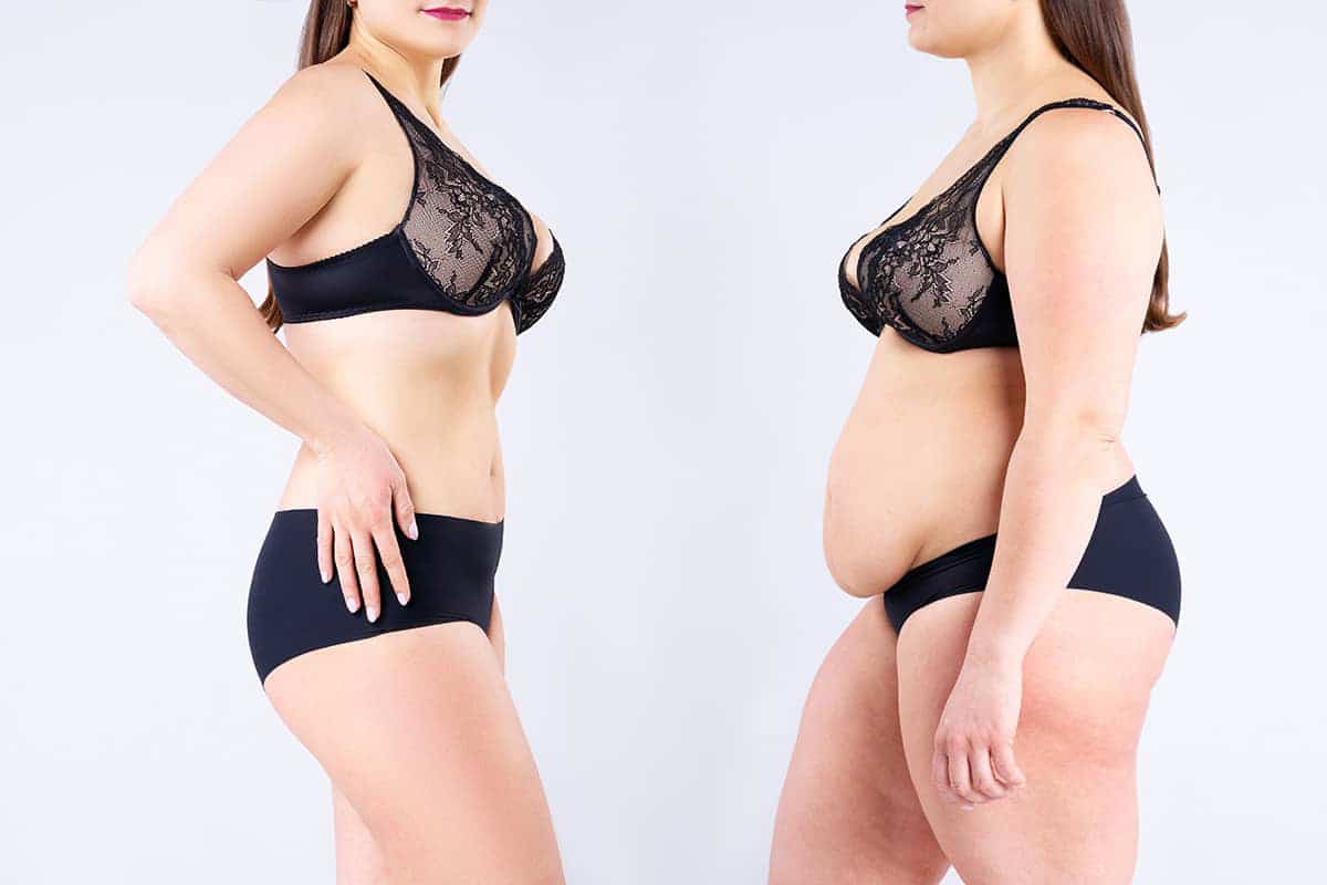 Tips for Surgery After Massive Weight Loss