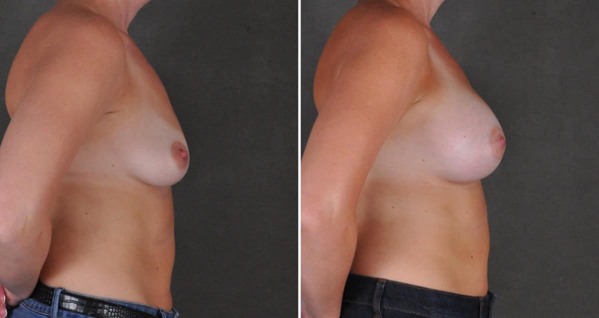 Breast Augmentation Before and After Photos in Omaha, NE, Case 10314