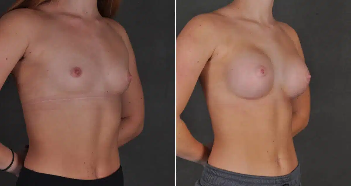 Breast Augmentation Before and After Photos in Omaha, NE, Case 10334