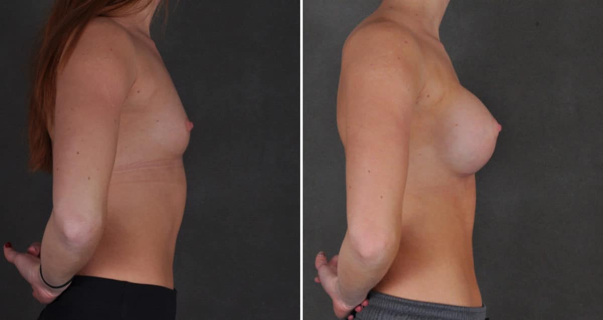 Breast Augmentation Before and After Photos in Omaha, NE, Case 10334