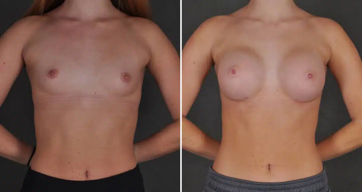 Breast Augmentation Before and After Photos in Omaha, NE, Case 10334