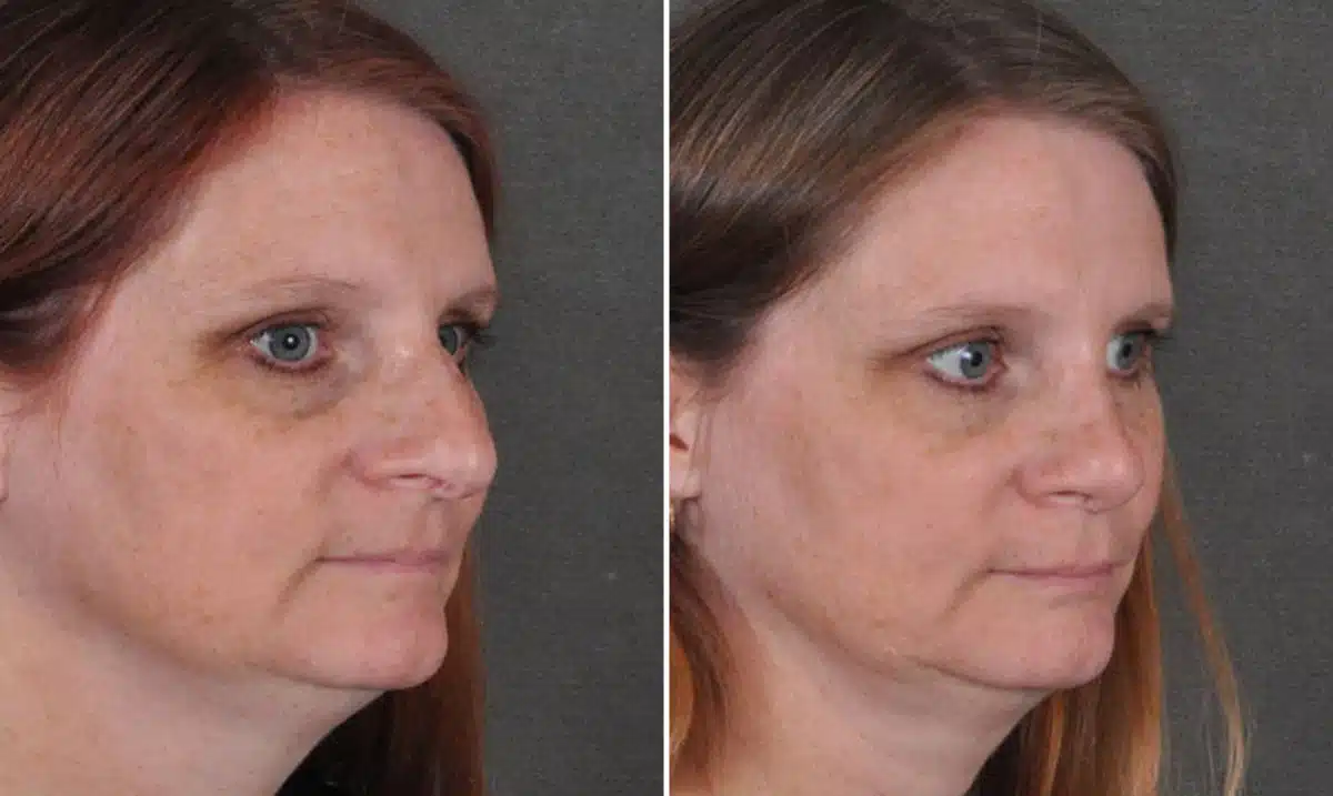 Rhinoplasty Before and After Photos in Omaha, NE, Case 16859