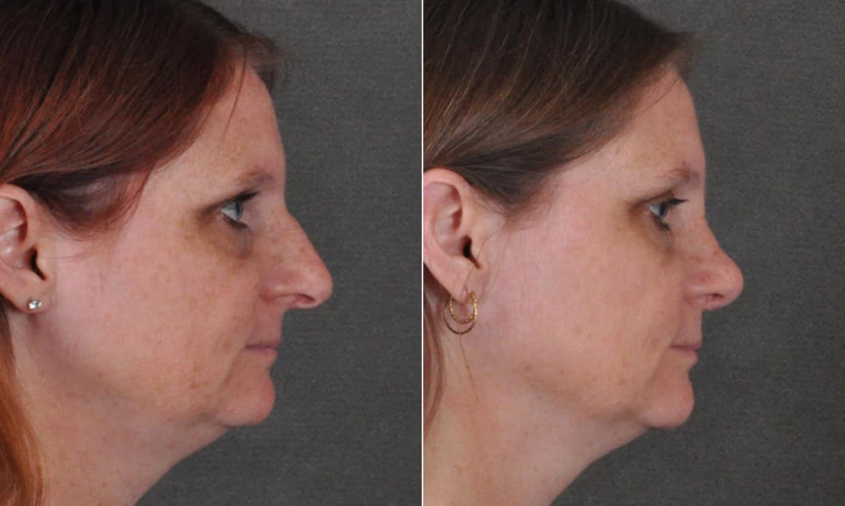 Rhinoplasty Before and After Photos in Omaha, NE, Case 16859