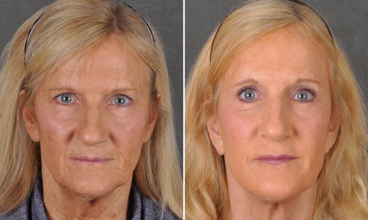 Facelift Before and After Photos in Omaha, NE, Case 16884