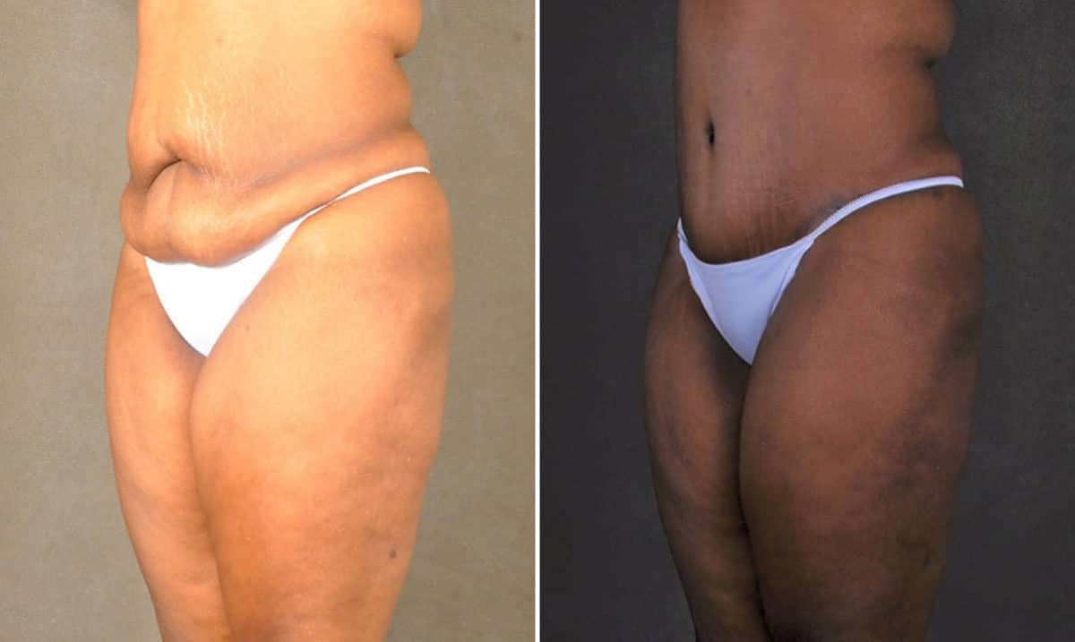 Tummy Tuck Before and After Photos in Omaha, NE, Case 17487